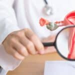 fibrome uterin et prise de poids 1