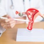 un fibrome calcifie peut il grossir 1